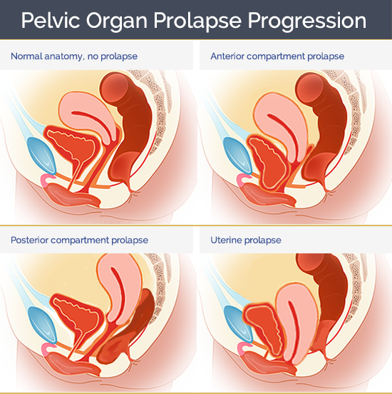 Pelvic Organ Prolapse Poster Ubicaciondepersonas Cdmx Gob Mx